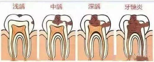 去补牙，怎么医生倒把牙洞越磨越大了？ 