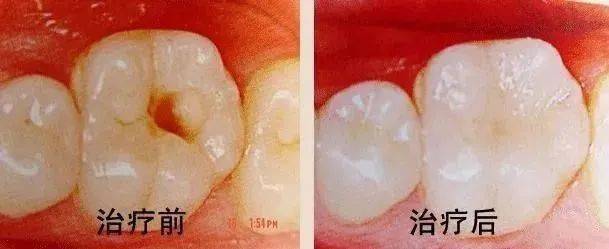 去补牙，怎么医生倒把牙洞越磨越大了？ 