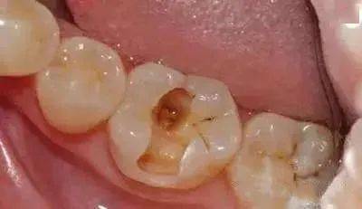 去补牙，怎么医生倒把牙洞越磨越大了？ 