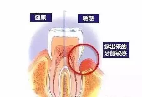 牙缝变大、牙齿松动、牙齿变敏感是不是牙被洗坏了?