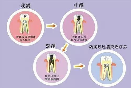 你的牙齿健康吗？牙齿早衰的六大信号要记牢