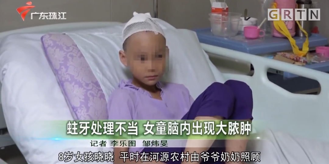 牙病处理不可轻视！8岁女童蛀牙致脑内长脓肿