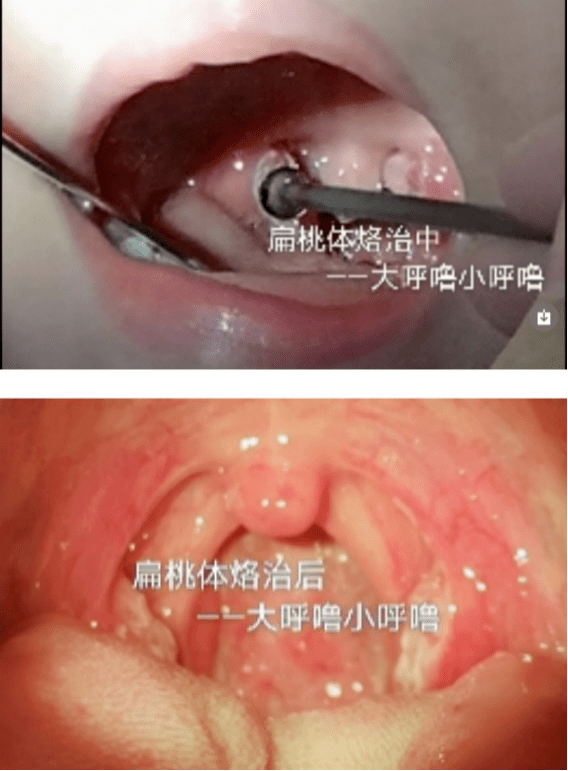 矫正牙齿前竟然要先看耳鼻喉科？ 