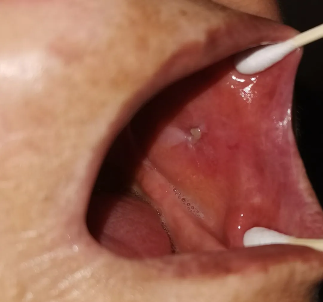 口腔溃疡竟是癌！原是假牙惹祸
