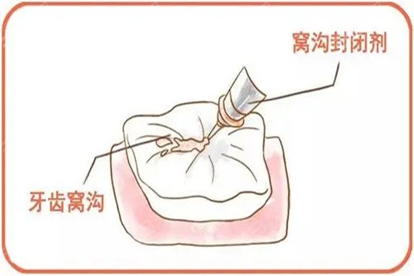 窝沟封闭