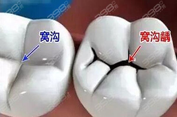 窝沟龋