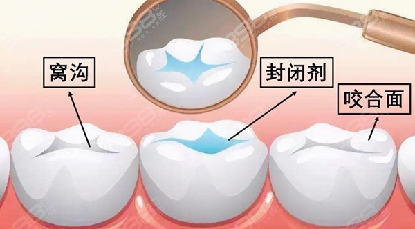 封闭剂