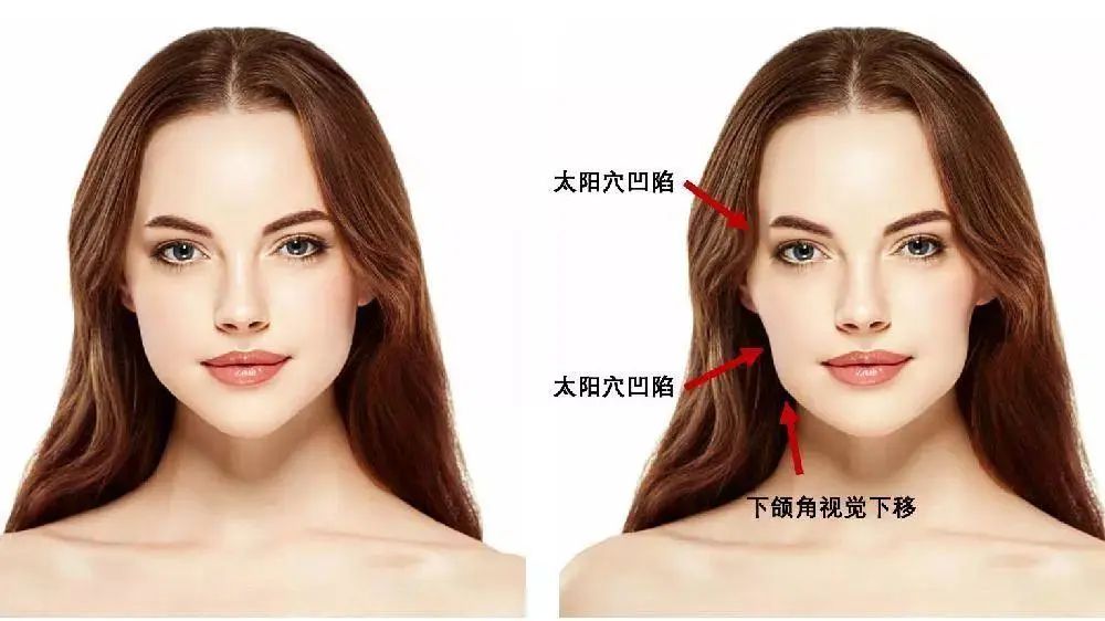 正畸如何预防牙套脸及法令纹