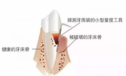 牙齿种植需要哪些条件