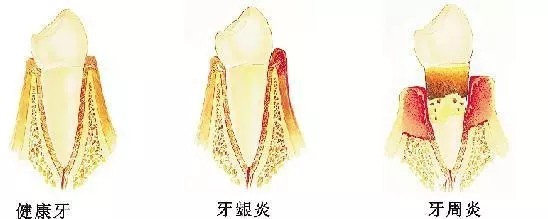 牙龈天天在萎缩！牙龈萎缩了该怎么办？
