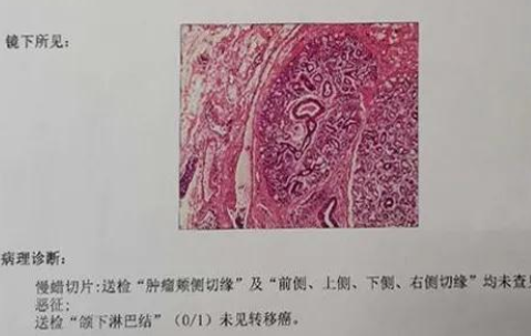 牙龈长“肉蛋”竟然是癌,专家提醒这个现象一定早诊治