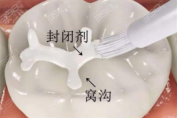 给孩子的牙齿穿上 “保护衣”：窝沟封闭的重要性不要忽视哦~
