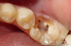 牙科-根管渗血处理法