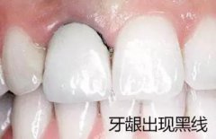 烤瓷牙变这样必须拆掉