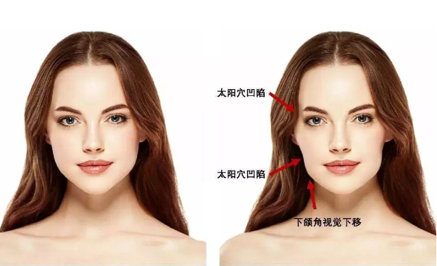 正畸如何预防牙套脸及法令纹