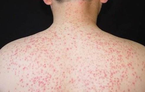 于方毛囊抑菌套装正规吗？治疗毛囊炎真的那么好吗？